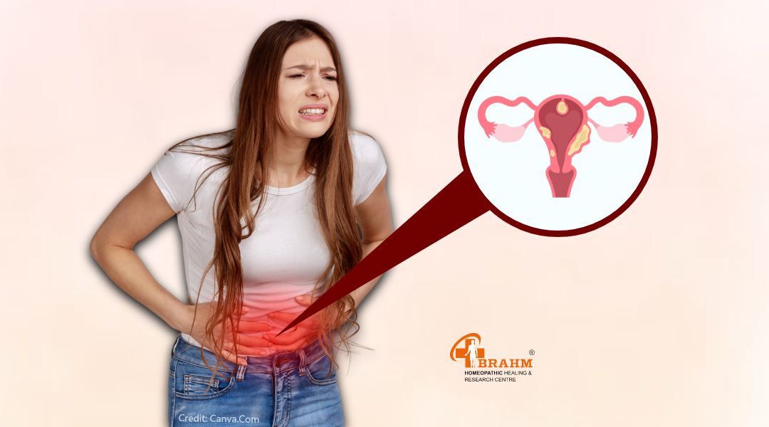 What is Uterine Fibroids